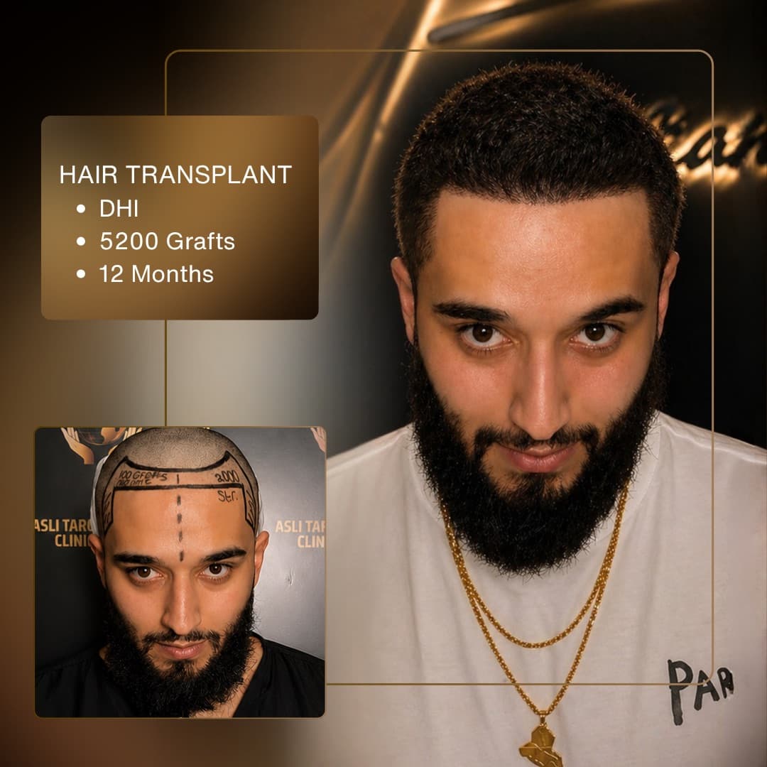 Before & After - DHI 5,200